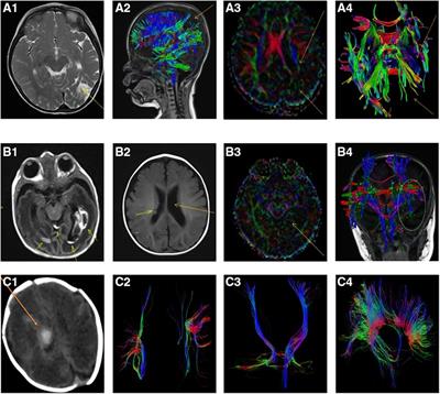 Microstructural changes of white matter assessed with diffusional kurtosis imaging in extremely preterm infants with severe intraventricular hemorrhage